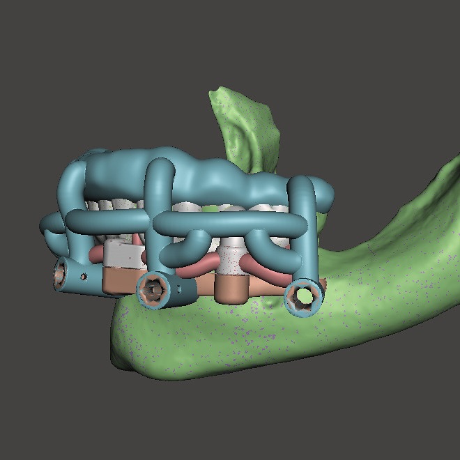 This recent stackable surgical guide case is a perfect example of how digital workflows streamline complex full-arch treatments - saving you time and improving surgical accuracy. 